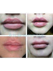 BLEU Beauty & Wellness - Lip Fillers