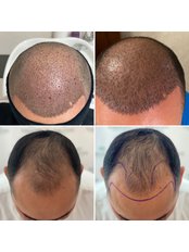 Noyan Health & Travel - Hair Transplantation ( Before - After )