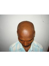 Dr. Rajguru Hair Care&Research Clinic - drrajguruhaircare&researchclinic-before treat