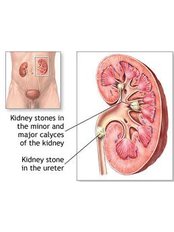 Kidney Stones Removal - Global Hospital