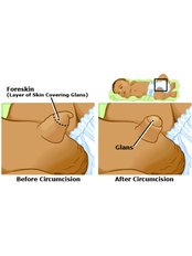 Circumcision - Global Hospital