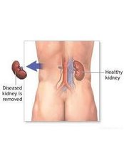 Kidney Removal - Global Hospital