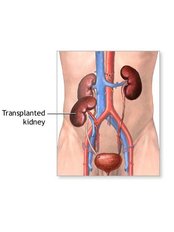 Kidney Transplant - Global Hospital