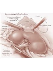 Kidney Removal - Mumbai Urology