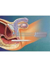 Prostate - Cryotherapy - Mumbai Urology