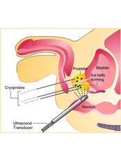 Prostate - Cryotherapy - Mumbai Urology
