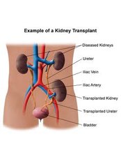Kidney Transplant - Mumbai Urology