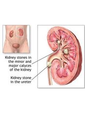 Kidney Stones Removal - Mumbai Urology