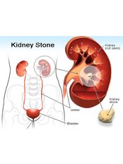 Kidney Stones Removal - Mumbai Urology