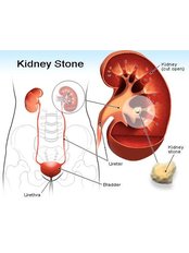 Kidney Stones Removal - Shivam Hospital