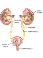 Kidney Removal - The Urologist Mumbai